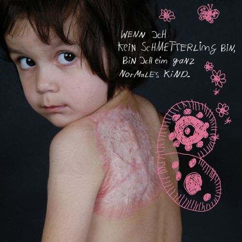 Mädchen mit Verbrennungsnarben auf dem Rücken blickt den Betrachter an