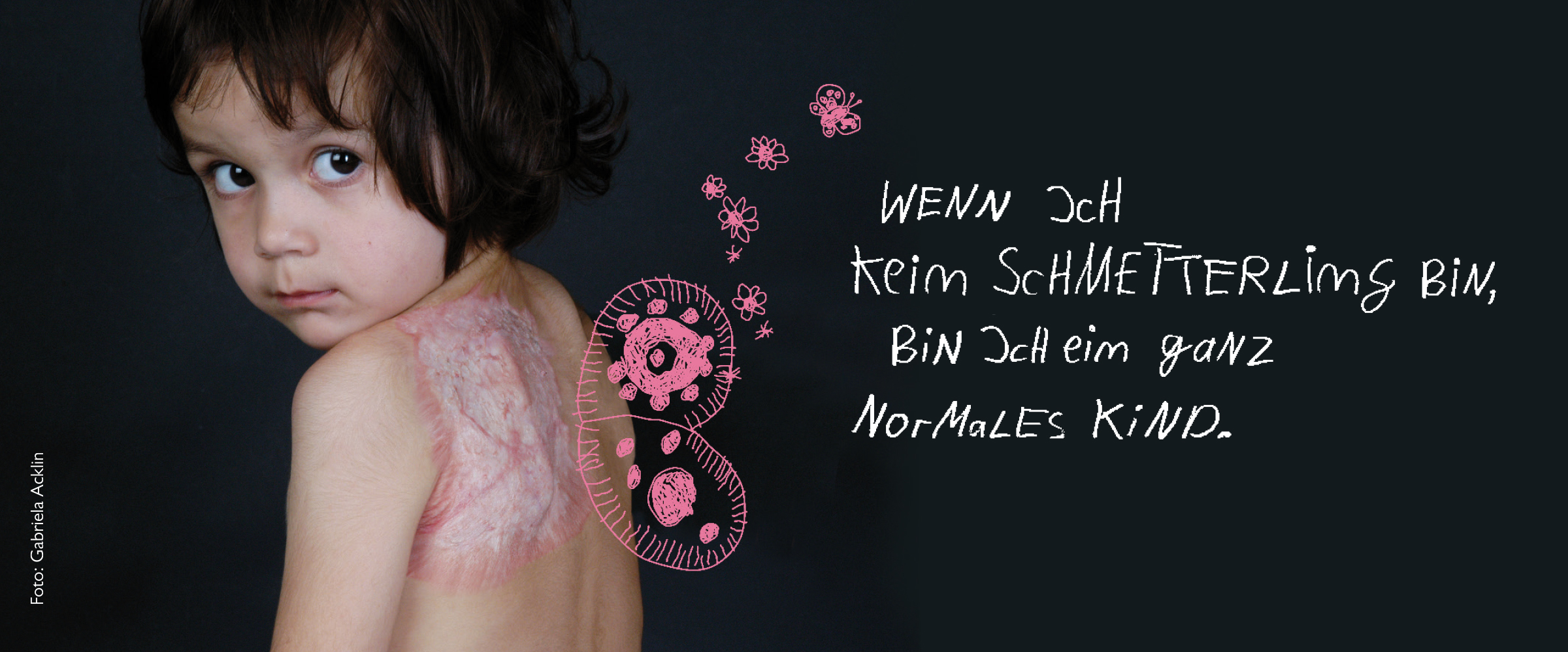Kampagnenposter zum Tag des brandverletzten Kindes von Paulinchen e.V.